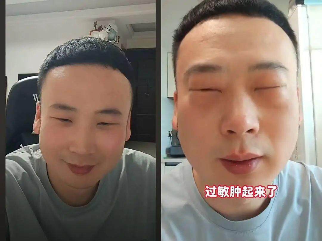张先生过敏前（左）后（右）