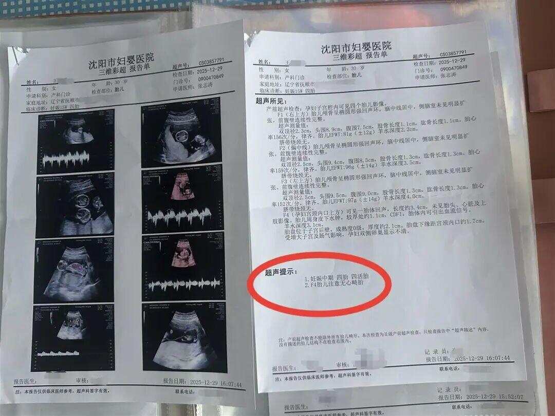 沈阳市妇婴医院彩超显示同卵四胞胎 当事人供图