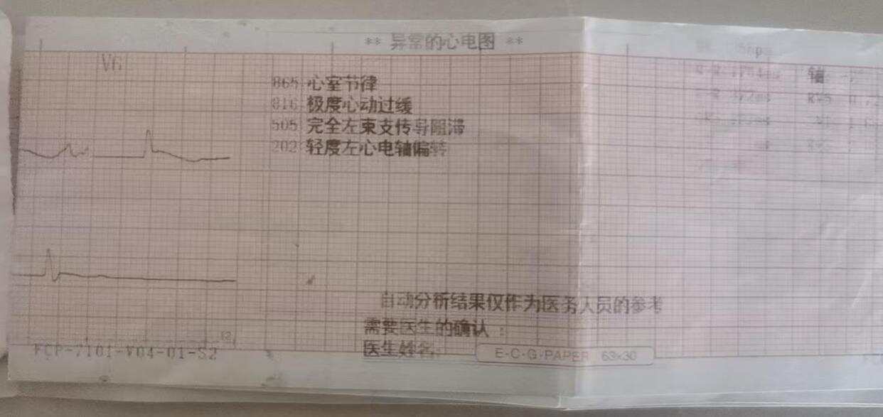 ▲心电图提示“极度心动过缓“