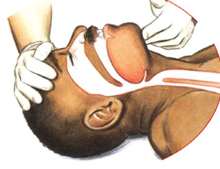 开放气道（压额抬颏法）