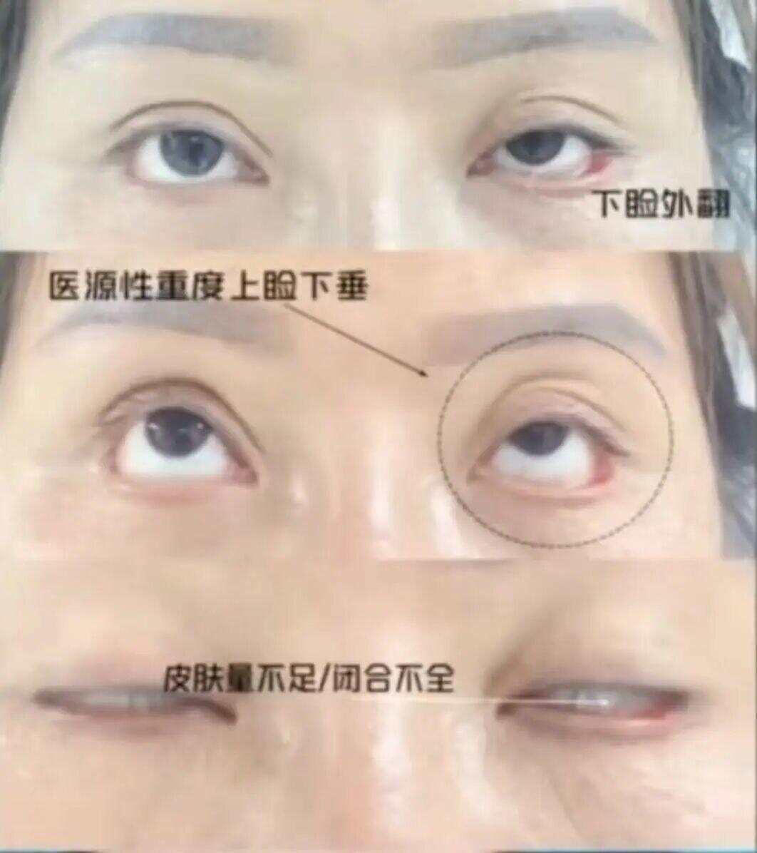 王丽眼睛闭合情况（受访者供图）