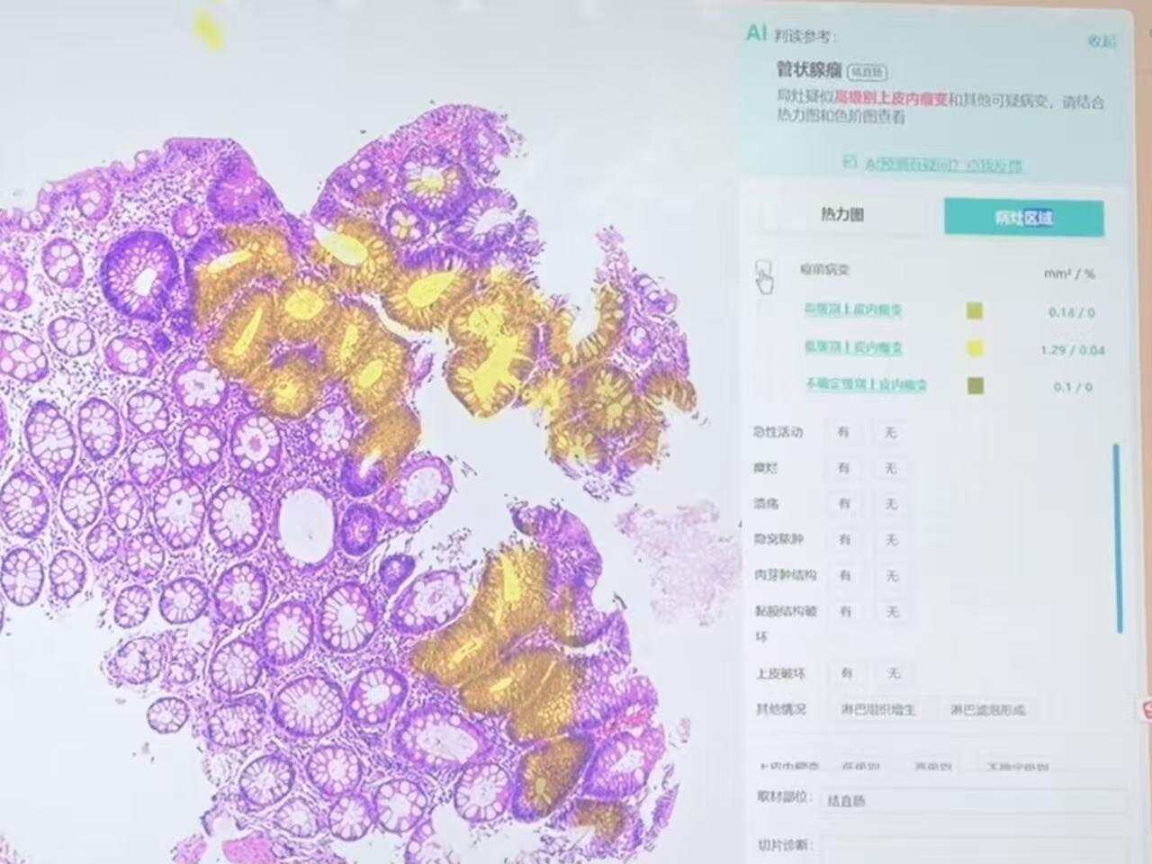 南方医院人工智能在病理辅助诊断中的应用 南方医院人工智能在病理辅助诊断中的应用