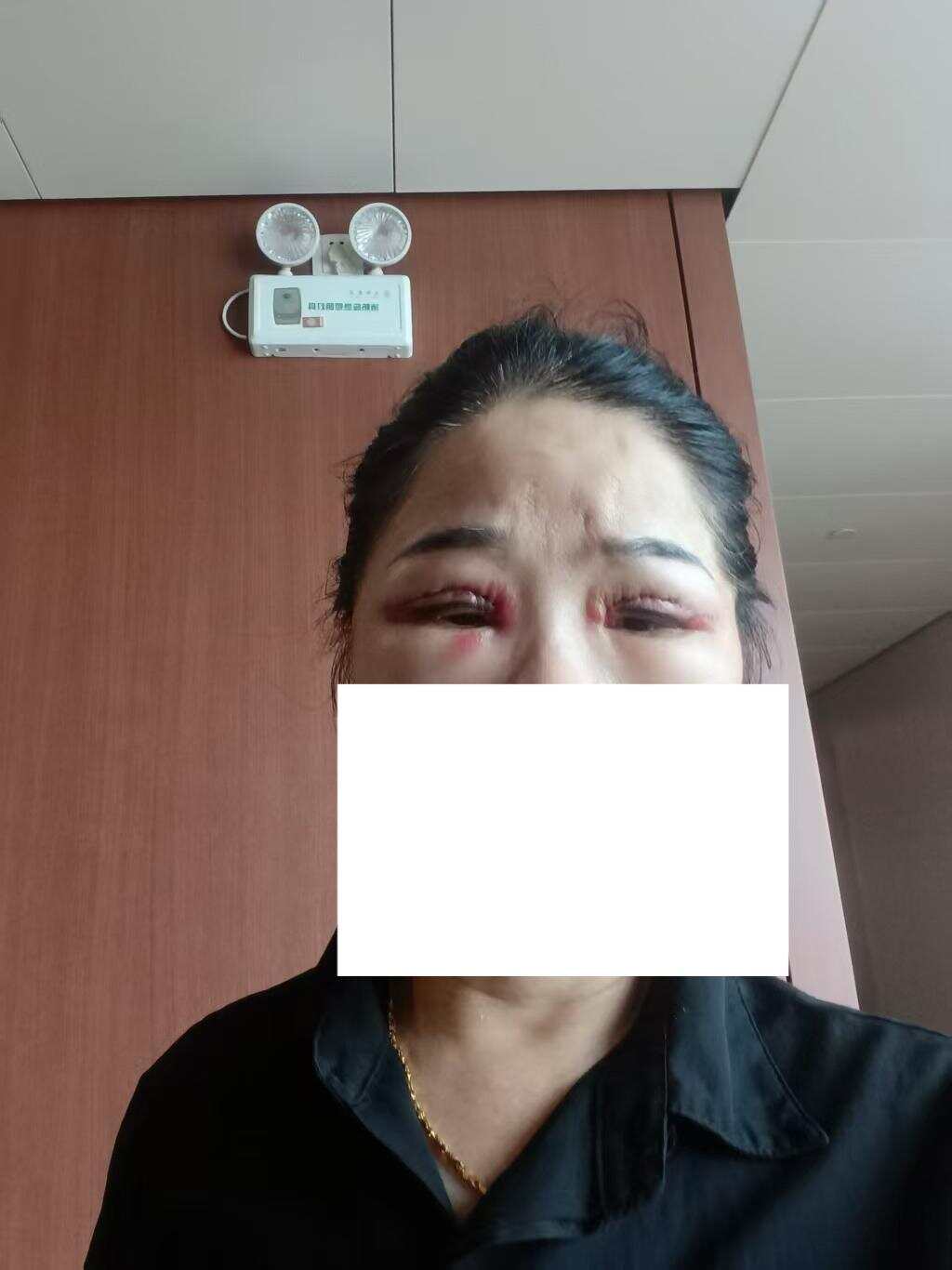 郑大姐术后双眼红肿明显 郑大姐术后双眼红肿明显